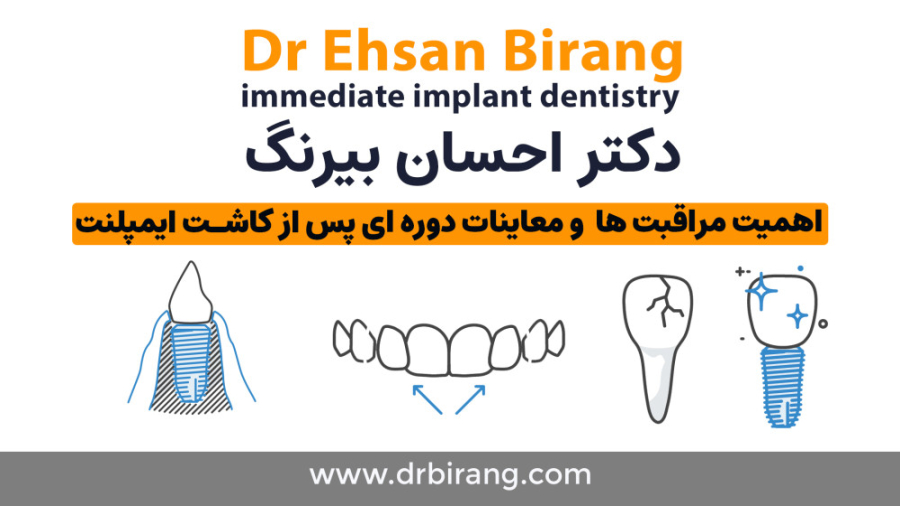 توجه به معاینات دوره ای و مراقبت های تخصصی ایمپلنت های تمام فک دیجیتال دکتر احسان بیرنگ