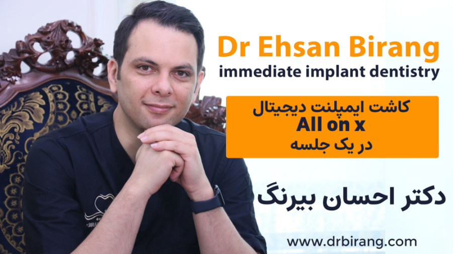 کاشت ایمپلنتall on x به روش دیجیتال در یک جلسه با هر تعداد ایمپلنت در تهران دکتر احسان بیرنگ