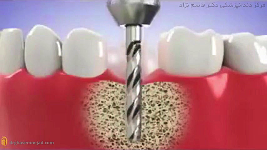 مینی ایمپلنت دندان دندانپزشکی زیبایی دکتر قاسم نژاد
