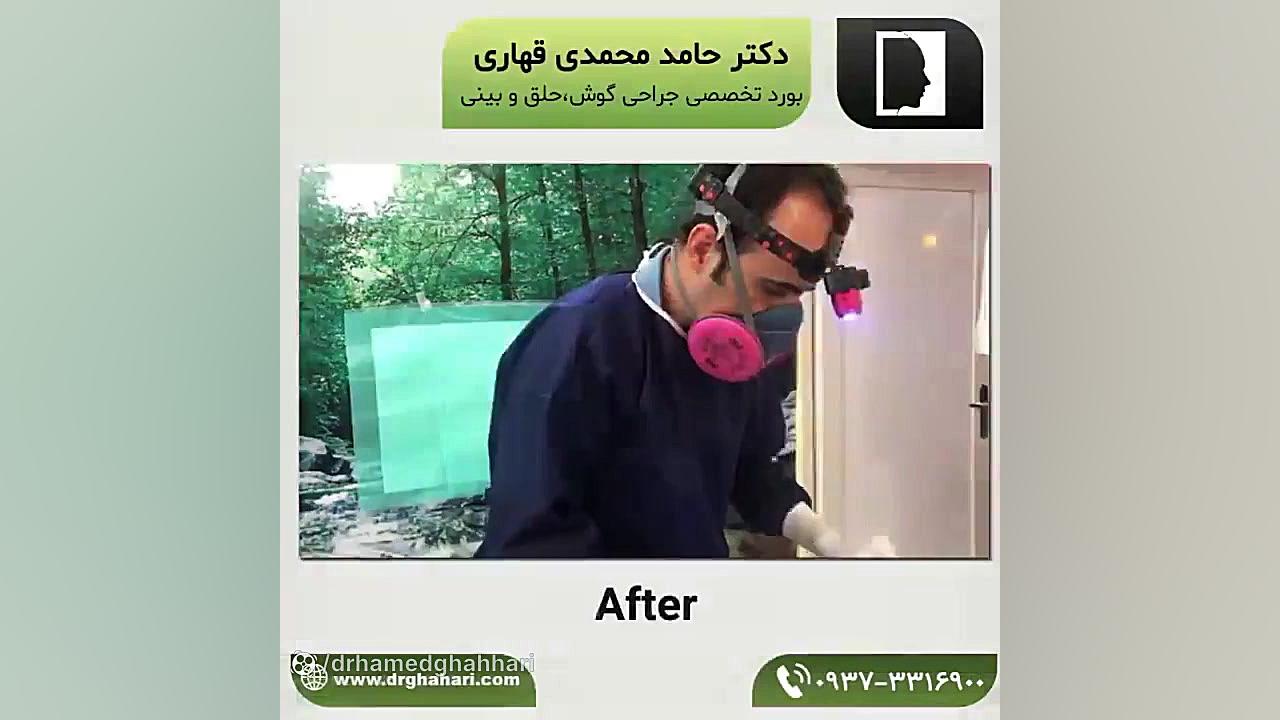 قبل و بعد از جراحی زیبایی گوش | دکتر قهاری دکتر حامد محمدی قهاری