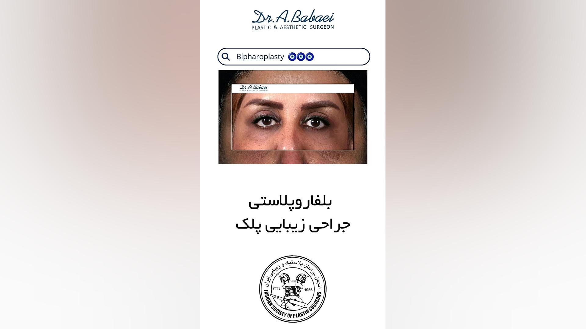 بلفاروپلاستی قبل و بعد دکتر علیرضا بابایی،فوق تخصص جراحی پلاستیک و زیبایی