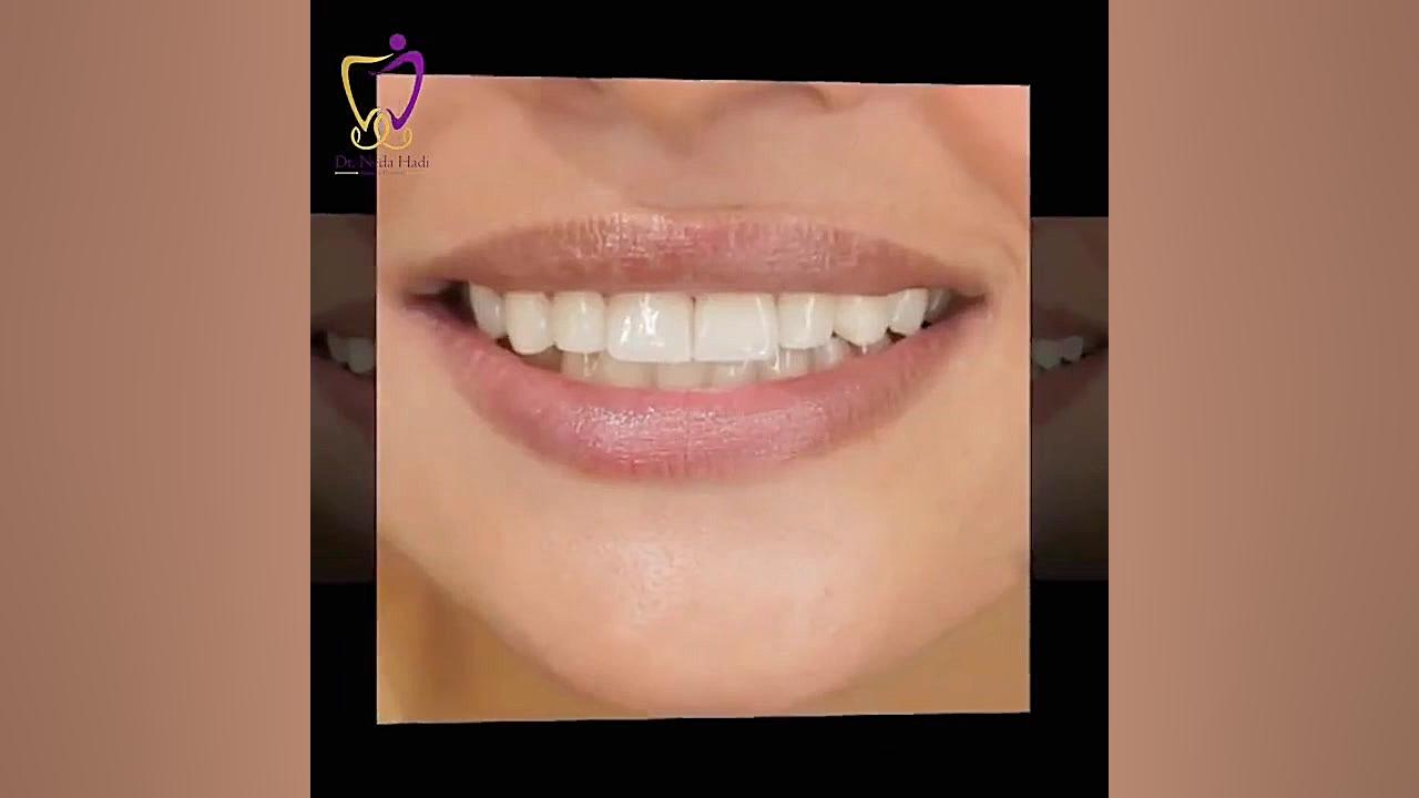 نمونه کار اصلاح طرح لبخند دکتر ندا هادی-دندانپزشک زیبایی