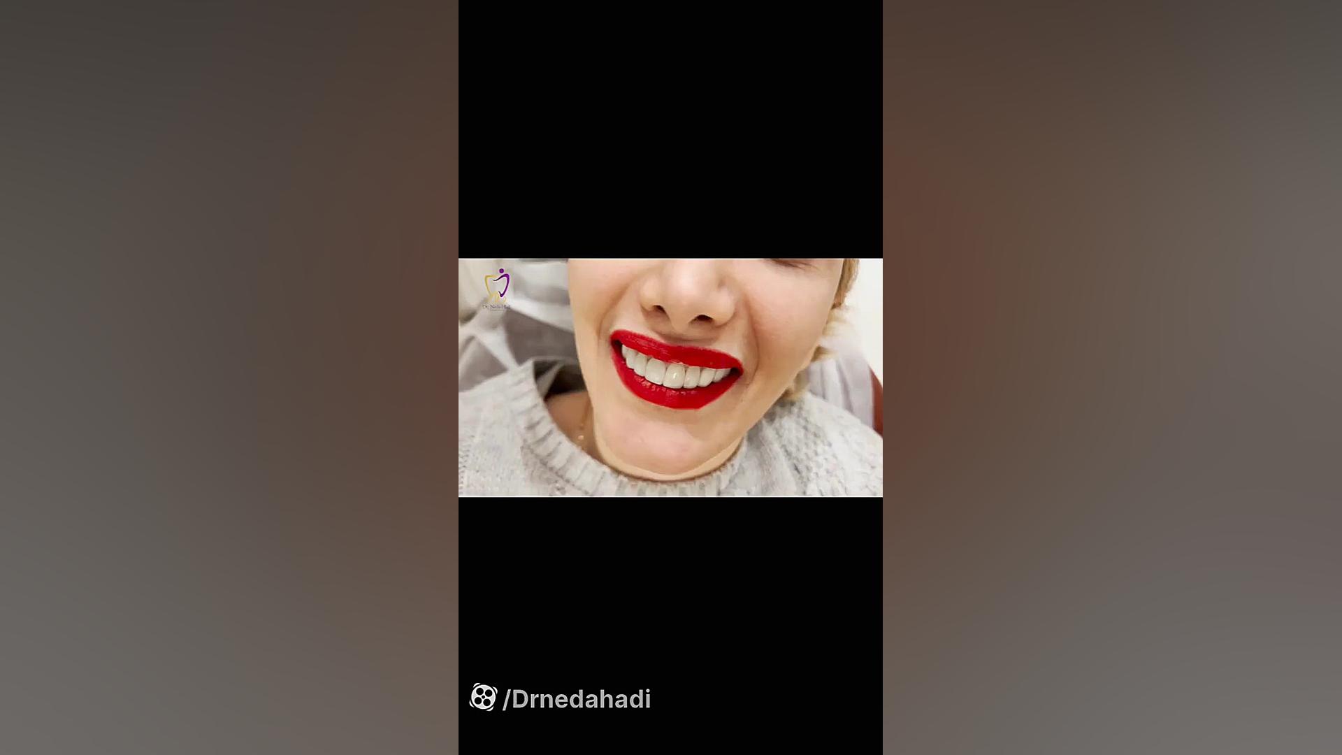 انجام کامپوزیت ونیر و اصلاح طرح لبخند برای فک بالا دکتر ندا هادی-دندانپزشک زیبایی