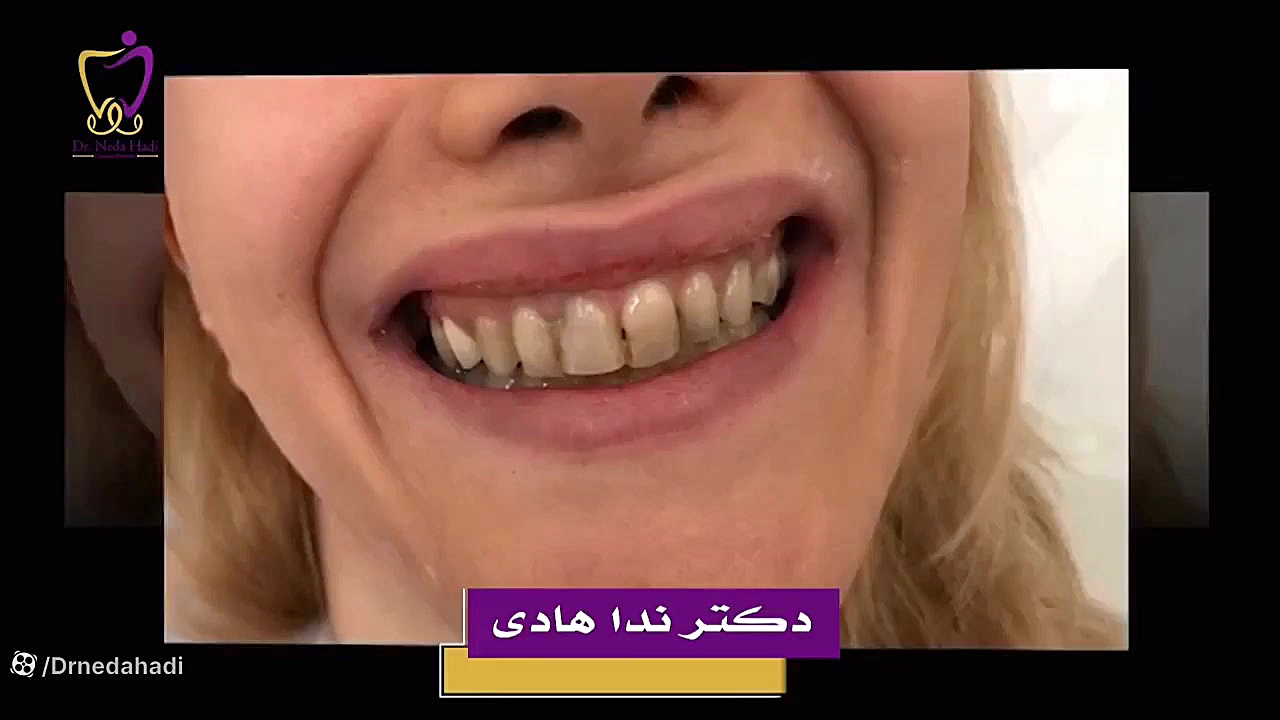 اصلاح طرح لبخند با کامپوزیت برای زیباجوی عزیز دکتر ندا هادی-دندانپزشک زیبایی