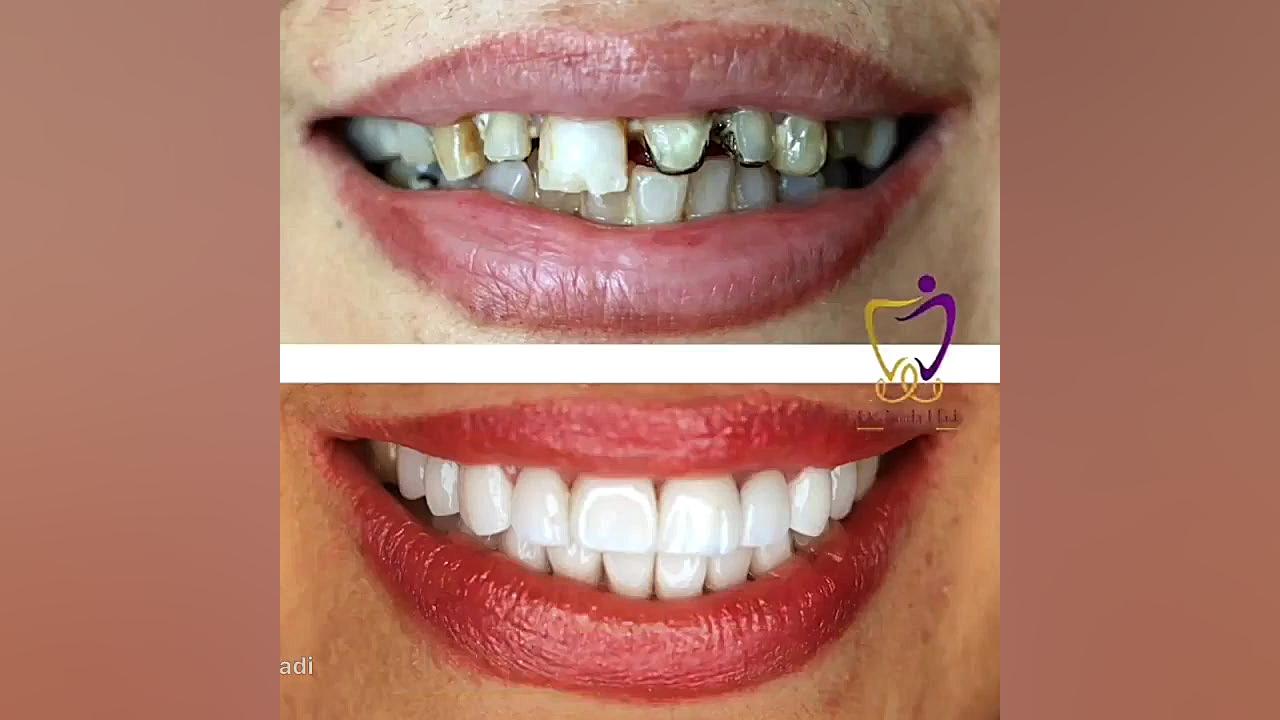 اصلاح طرح لبخند برای زیباجوی عزیزمون دکتر ندا هادی-دندانپزشک زیبایی