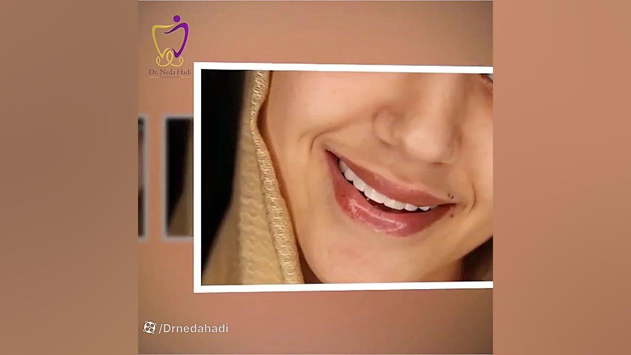 اصلاح طرح لبخند برای زیباجو دکتر ندا هادی-دندانپزشک زیبایی