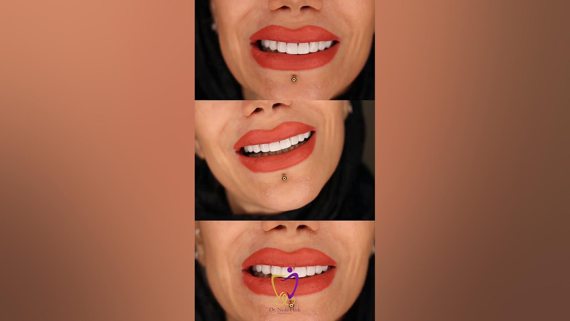اصلاح طرح لبخند با کامپوزیت برای زیباجوی عزیزمون دکتر ندا هادی-دندانپزشک زیبایی