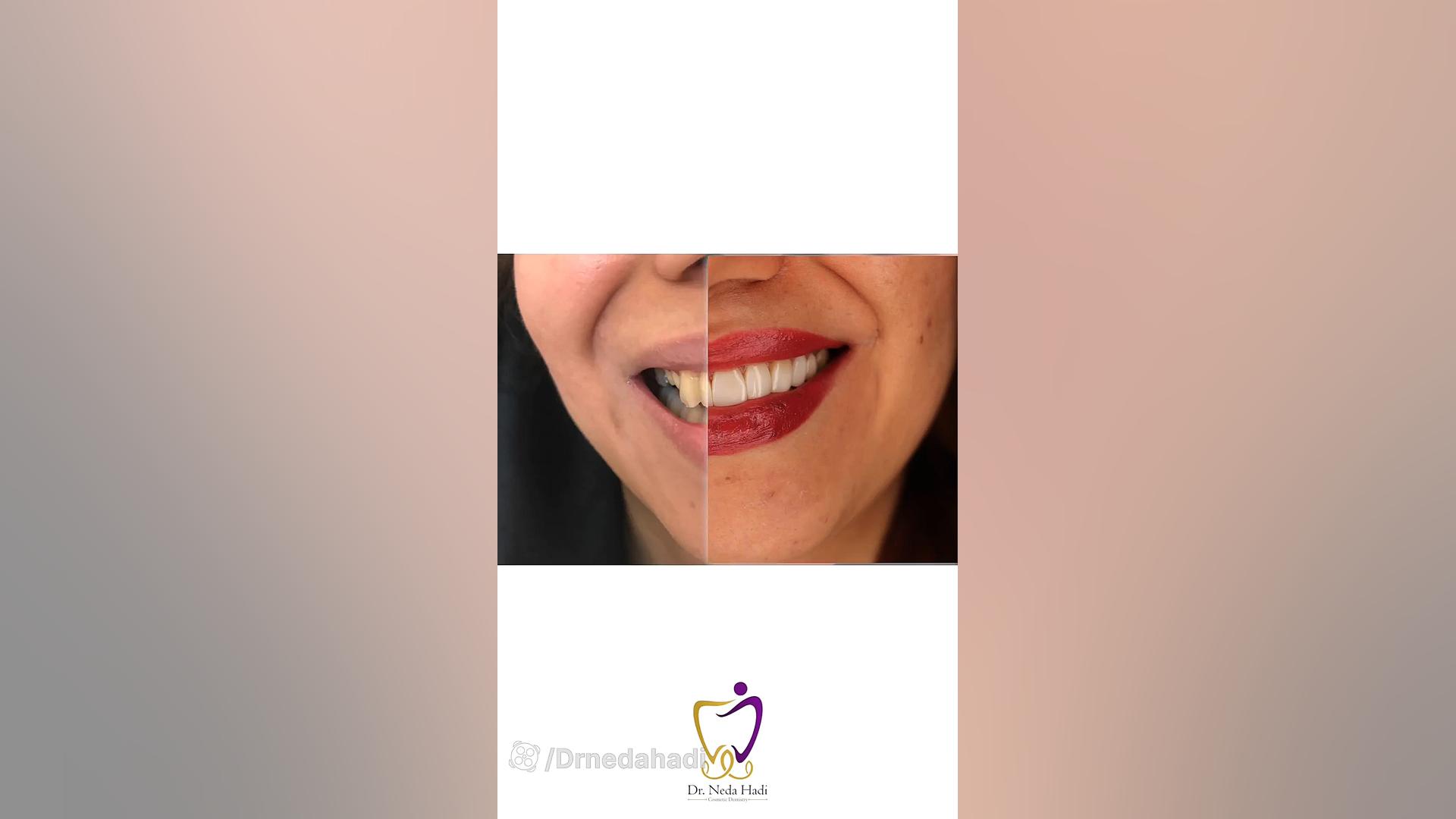 کامپوزیت برای زیباجوی عزیزمون دکتر ندا هادی-دندانپزشک زیبایی