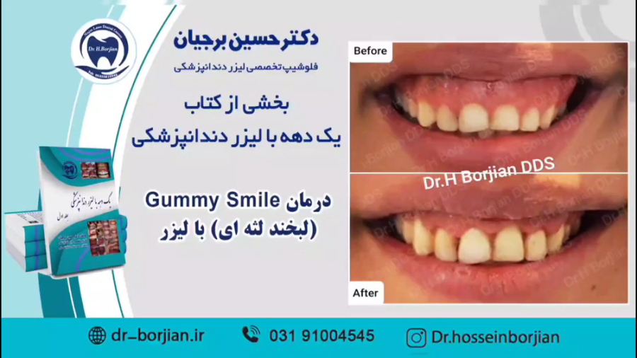 بخشی از کتاب یک دهه با لیزر دندانپزشکی | درمان لبخند لثه ای با لیزر ChIP-Chip