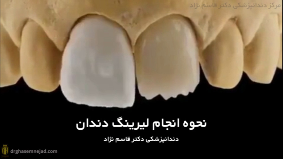 تکنیک لیرینگ دندان دندانپزشکی زیبایی دکتر قاسم نژاد