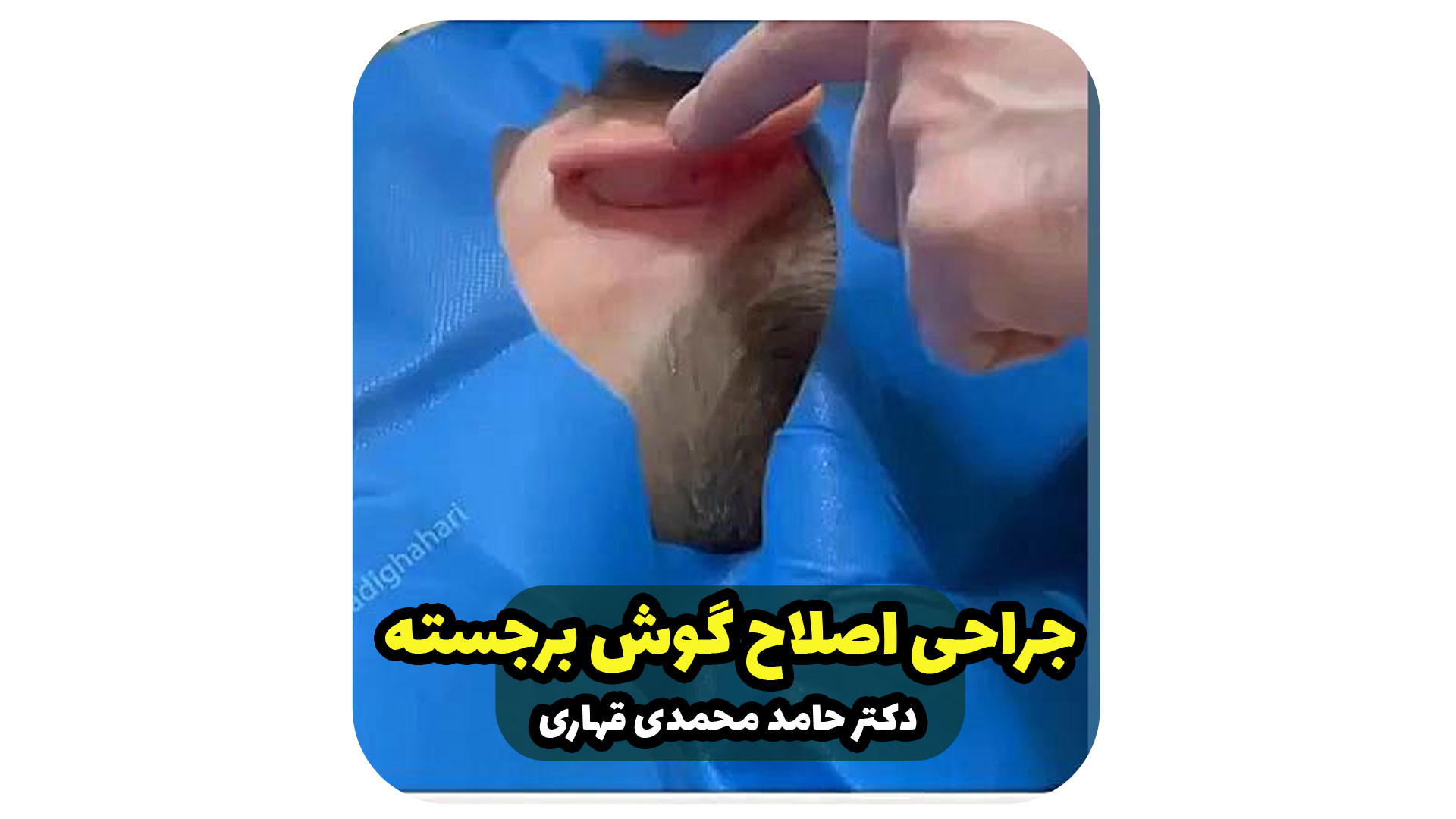 جراحی اصلاح گوش برجسته | دکتر قهاری دکتر حامد محمدی قهاری