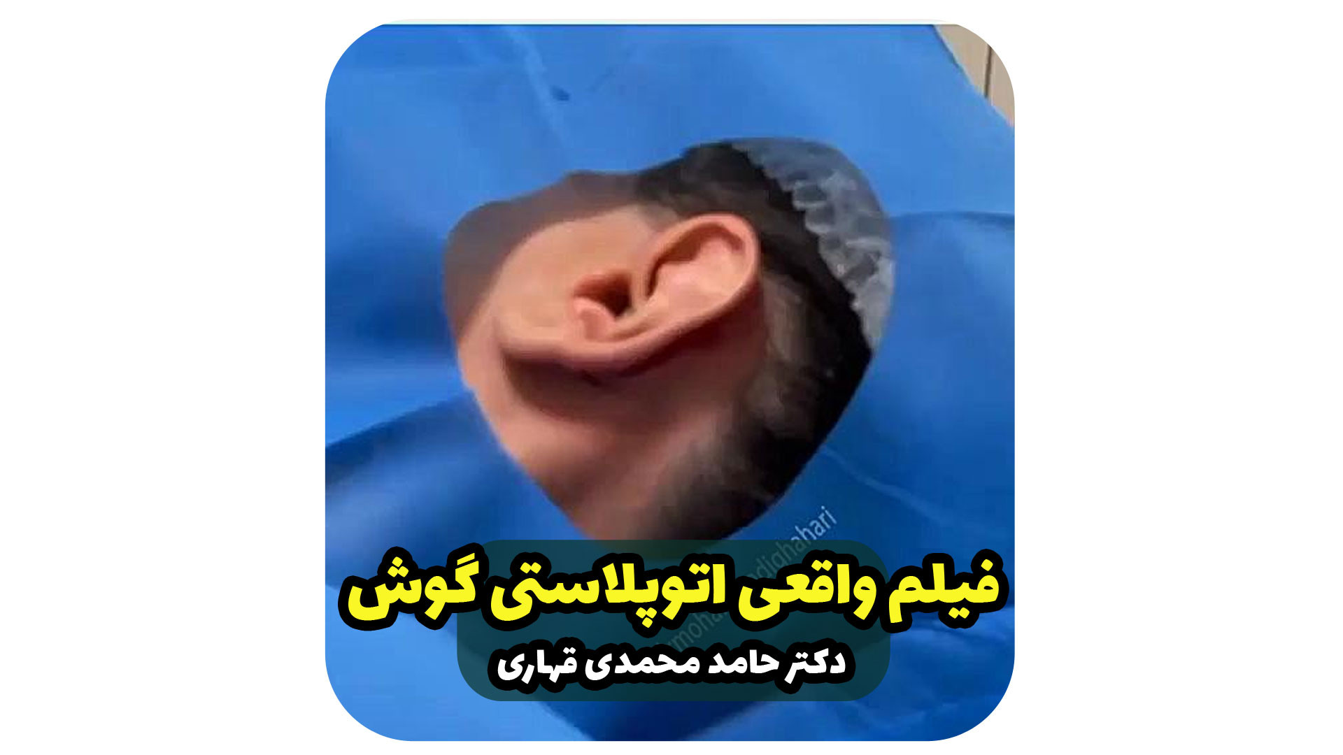 فیلم واقعی اتوپلاستی گوش دکتر حامد محمدی قهاری