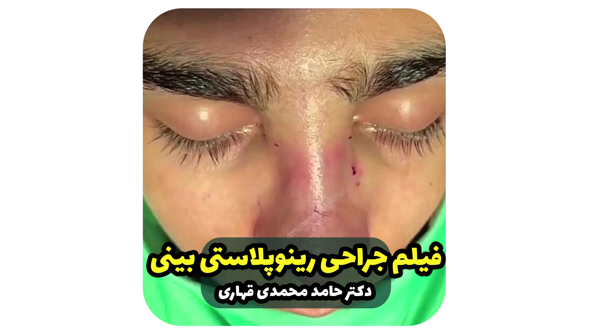 فیلم جراحی رینوپلاستی بینی دکتر حامد محمدی قهاری