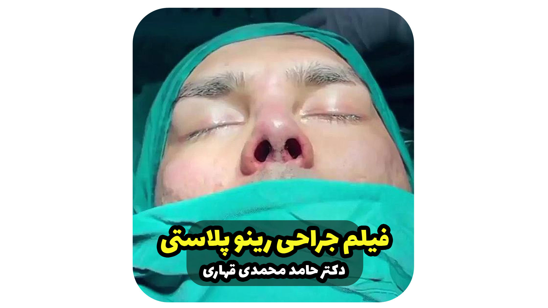 فیلم جراحی رینو پلاستی دکتر حامد محمدی قهاری