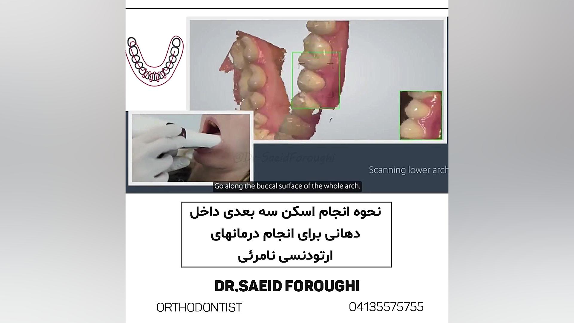 نحوه انجام اسکن سه بعدی داخل دهانی برای انجام درمان های ارتودنسی نامرئی دکتر سعید فروغی متخصص ارتودنسی