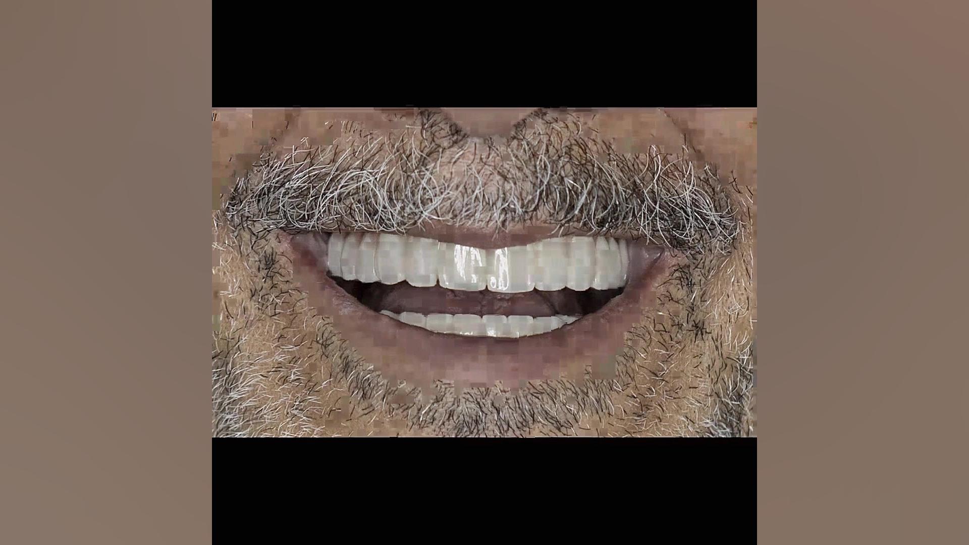خلق لبخندی زیبا برای مراجعه کننده عزیزمون دکتر عباس گشاده رو، متخصص جراحی لثه و ایمپلنت