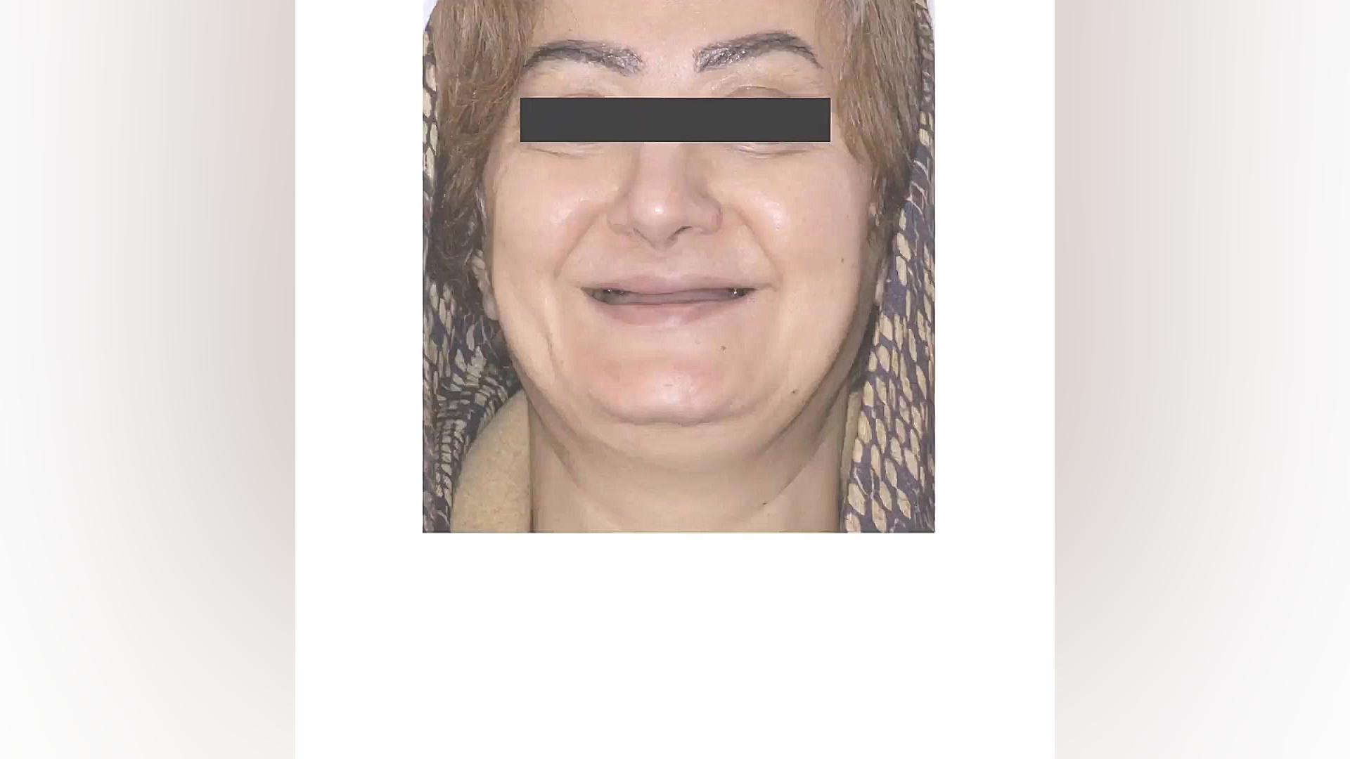لبخندهای زیبای مراجعین که نویدبخش زیباترین لحظات است... دکتر عباس گشاده رو، متخصص جراحی لثه و ایمپلنت