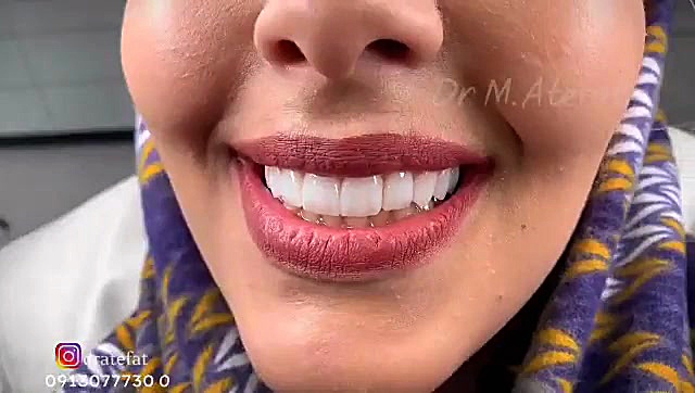ونیر کامپوزیت 10 دندان فک بالا و بلیچینگ فک پایین | دندانپزشکی زیبایی در اصفهان دکتر محمد عاطفت متخصص ترمیمی و زیبایی اصفهان