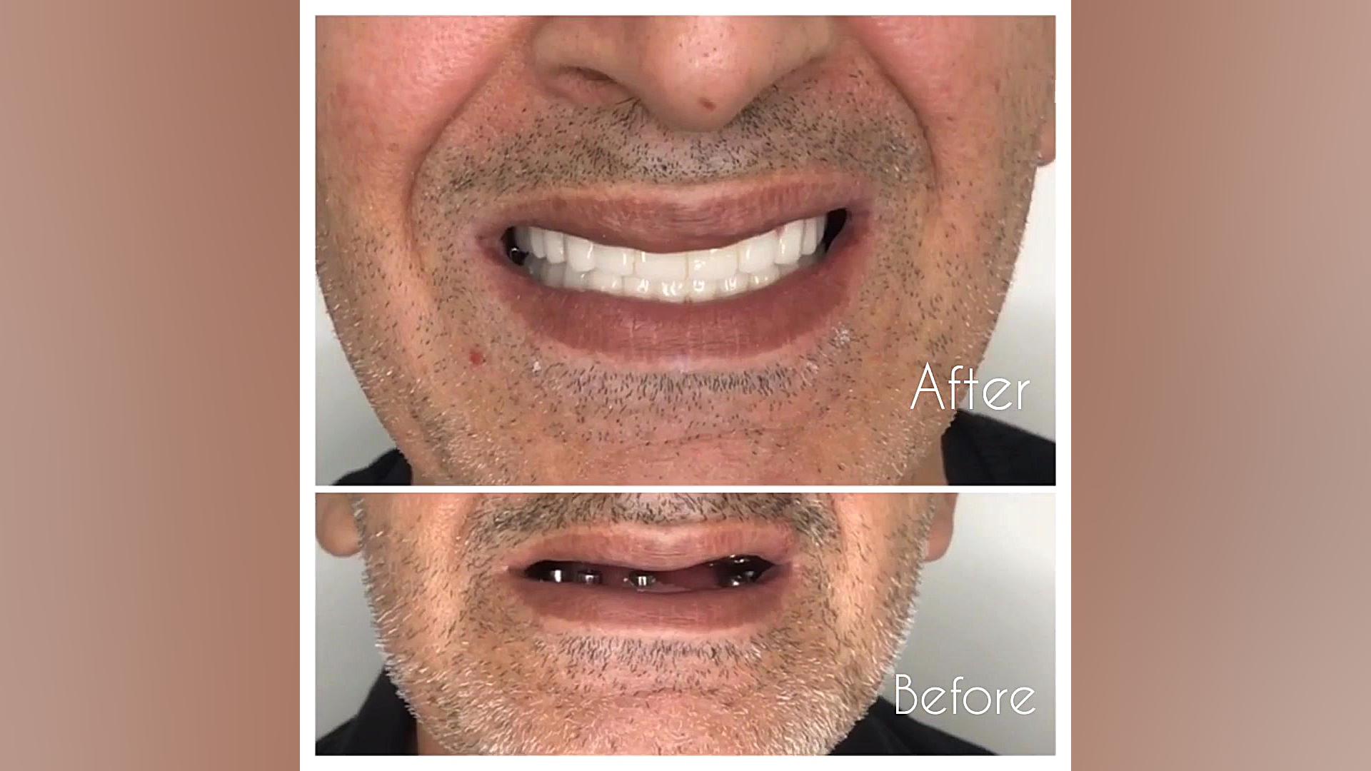 طراحی و اصلاح طرح لبخند با بازسازی دندان های دو فک دکتر عباس گشاده رو، متخصص جراحی لثه و ایمپلنت