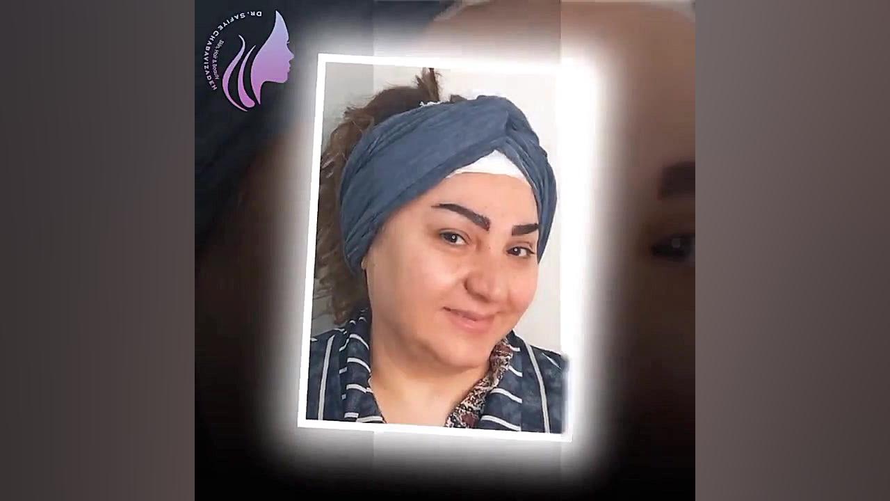 کاشت ابرو و کاور تتو دکتر صفیه چعباوی زاده