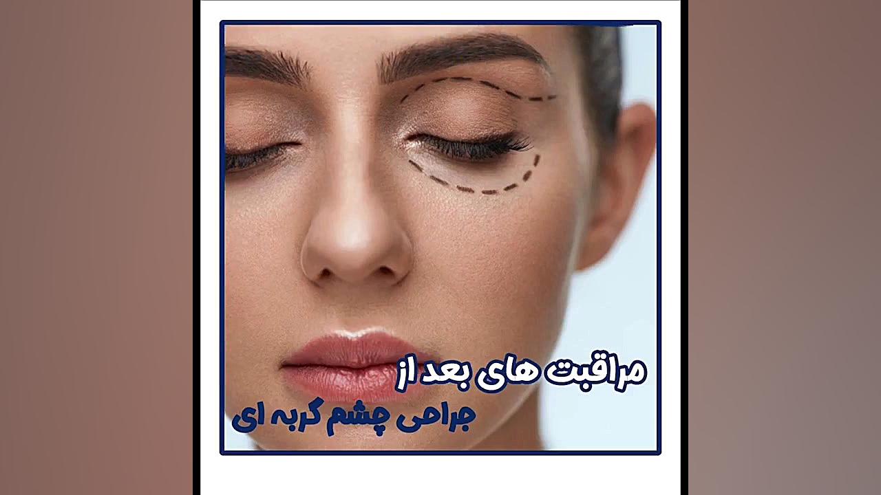 مراقبت های لازم بعد از جراحی چشم گربه ای . RNA Interference Assay