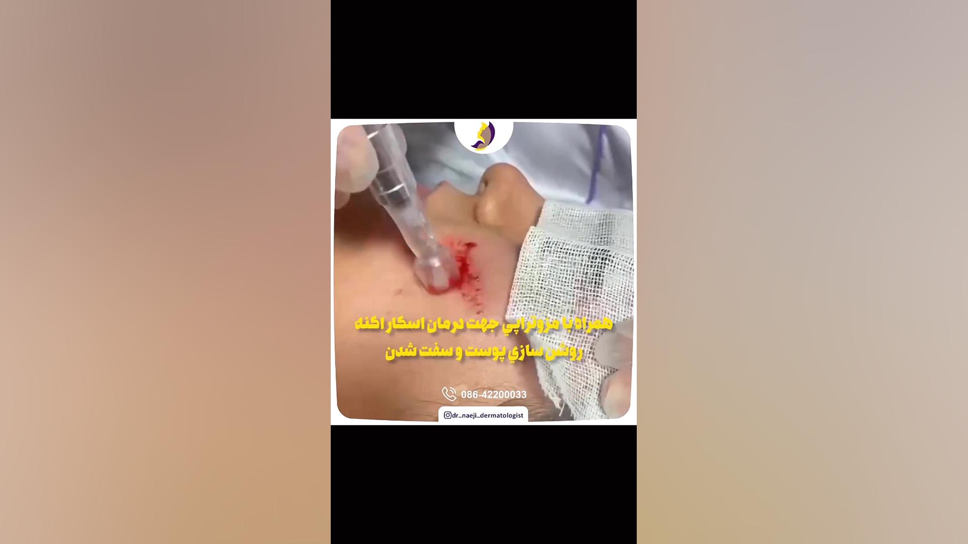 فیلم واقعی از مزونیدلینگ دکتر صدیقه نائیجی | متخصص پوست و مو در قم