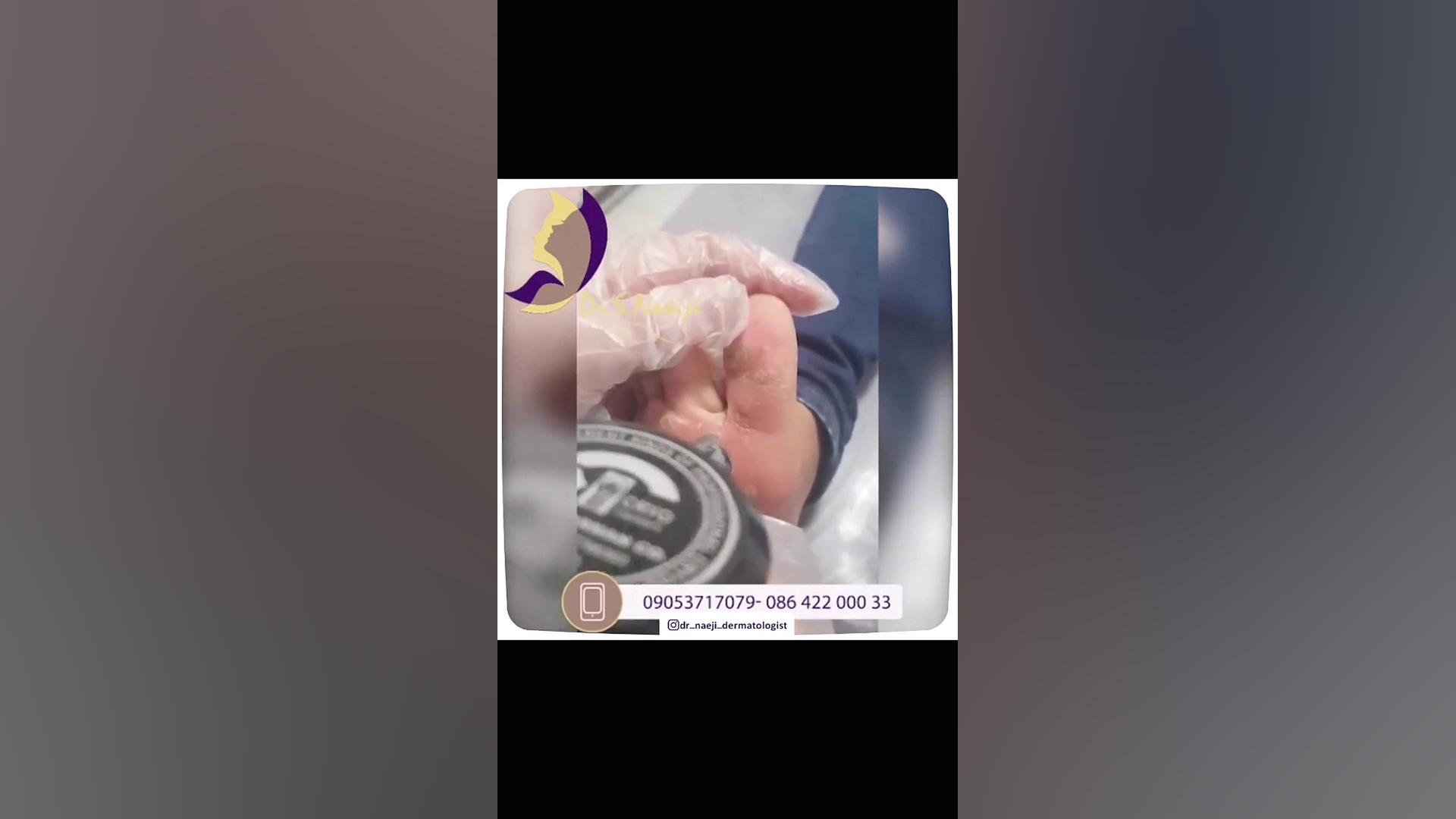 فیلم واقعی از کرایوتراپی با نیتروژن مایع دکتر صدیقه نائیجی | متخصص پوست و مو در قم