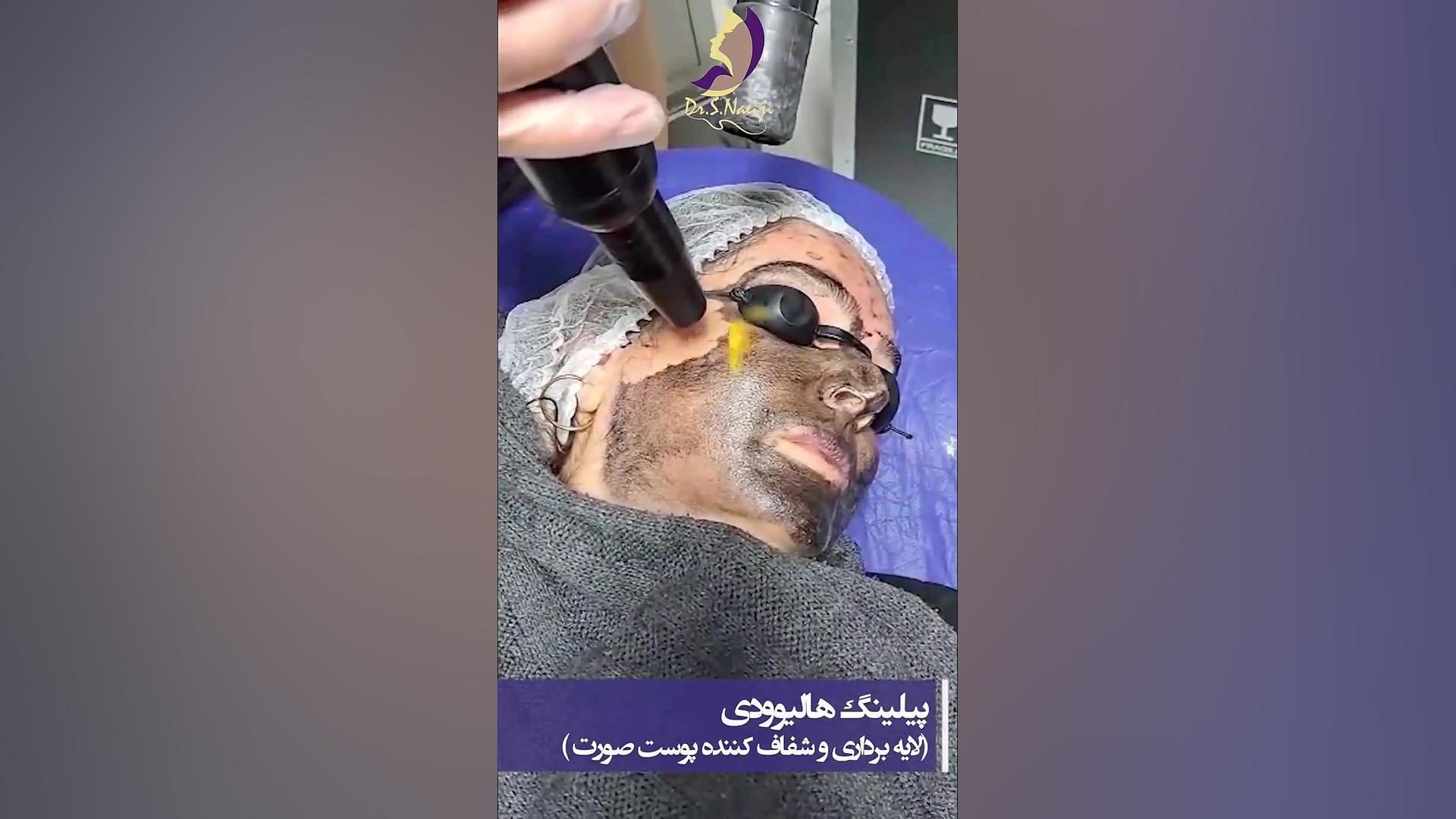 فیلم واقعی از پیلینگ هالیوودی دکتر صدیقه نائیجی | متخصص پوست و مو در قم