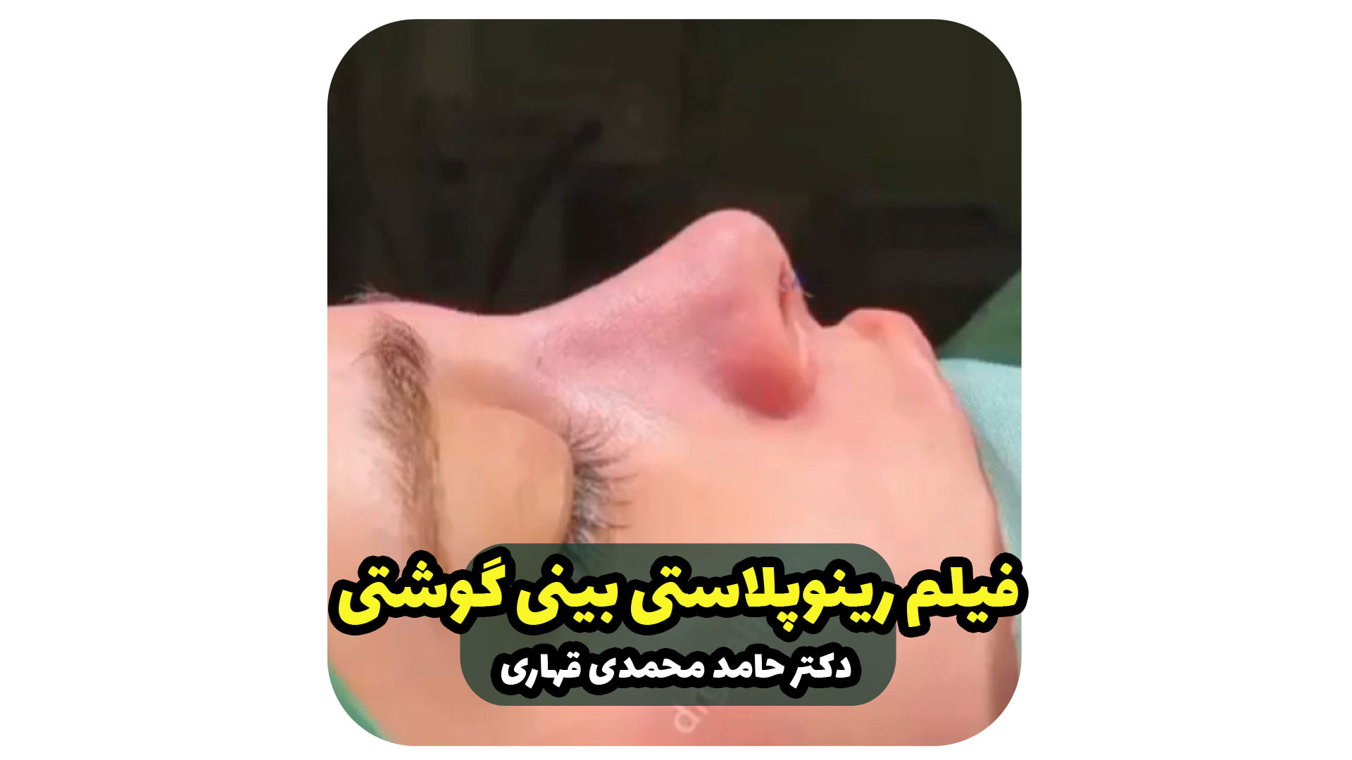 فیلم رینوپلاستی بینی گوشتی دکتر حامد محمدی قهاری