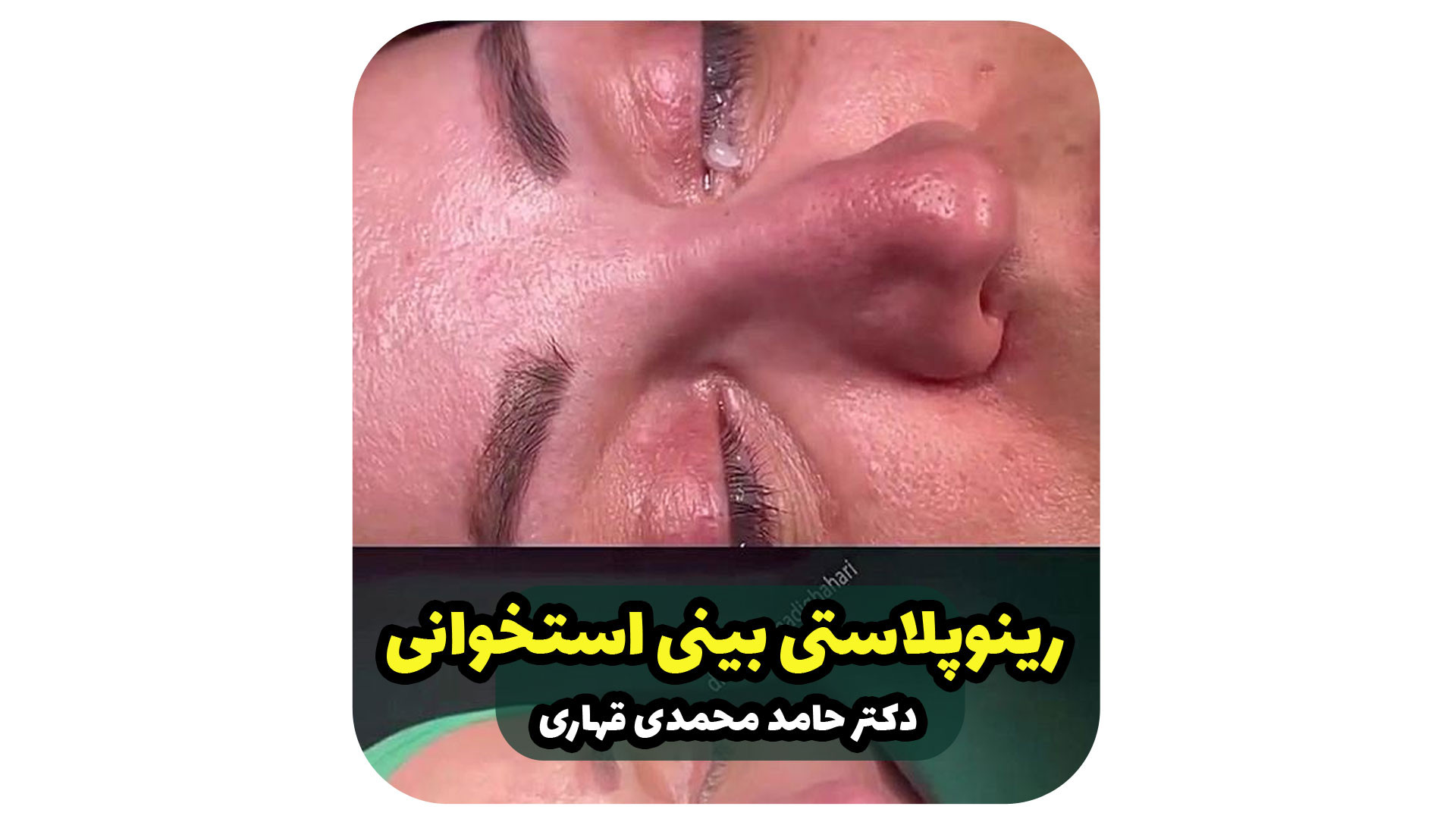 فیلم عمل رینوپلاستی بینی استخوانی دکتر حامد محمدی قهاری