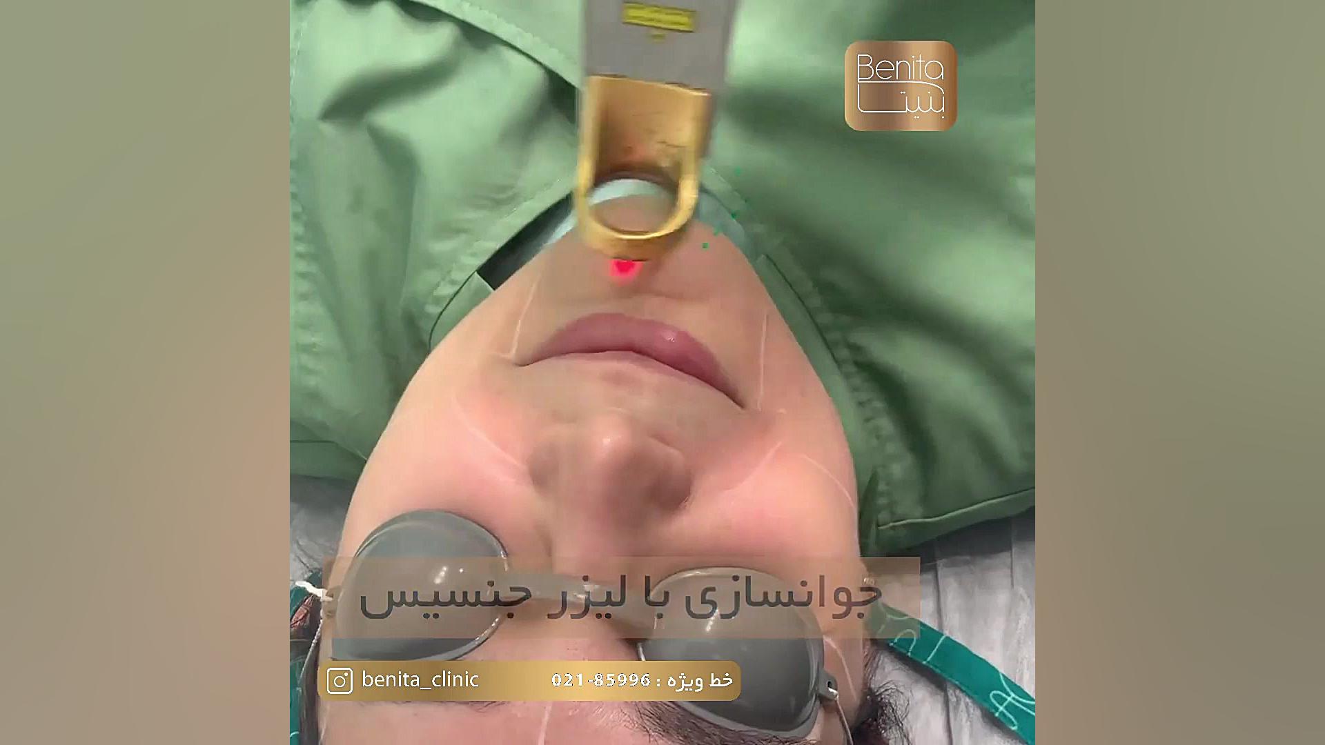 جوانسازی پوست صورت با لیزر جنسیس دستگاه DNA-Chip