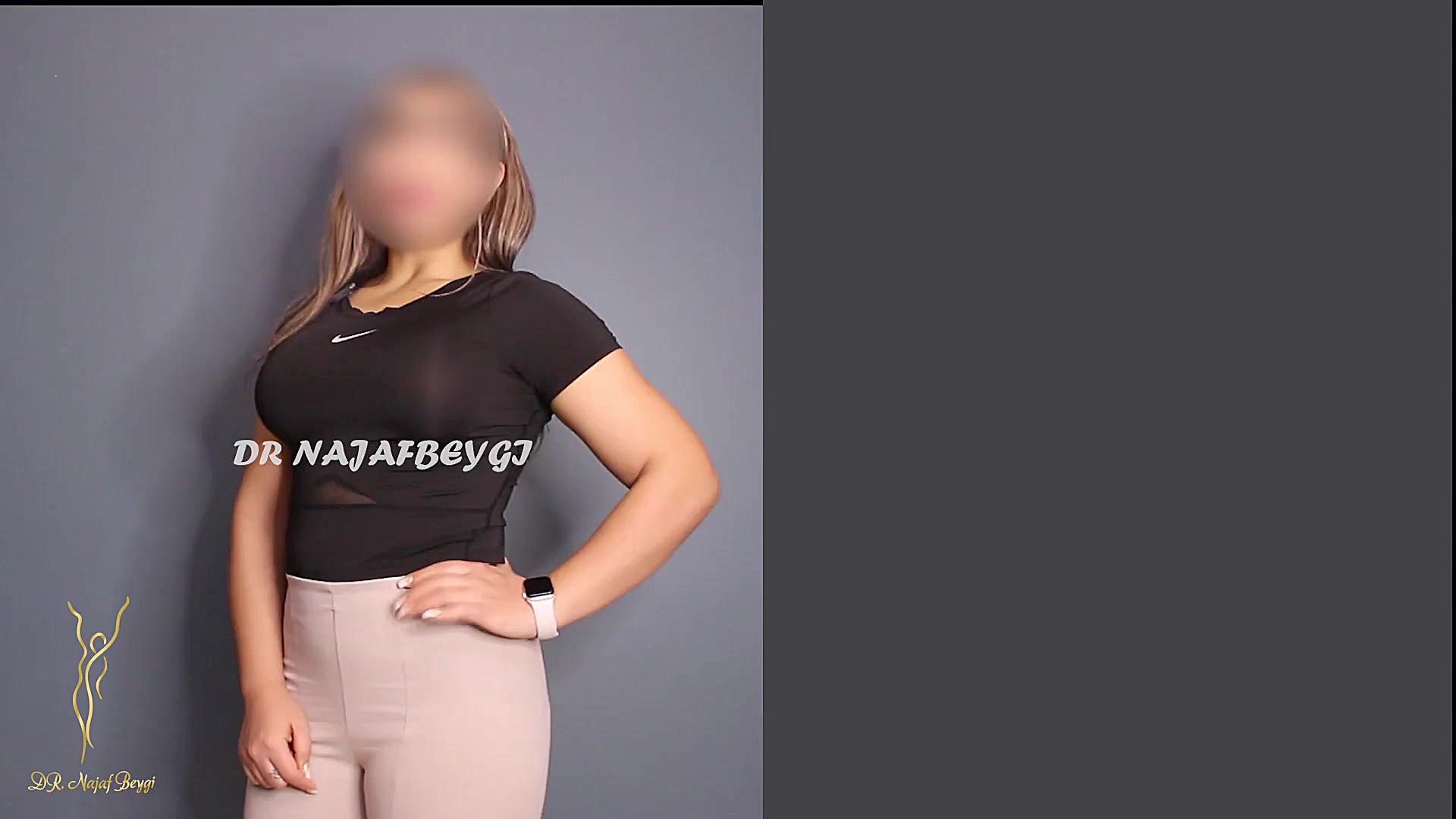 پروتز سینه ایریدوتيكان