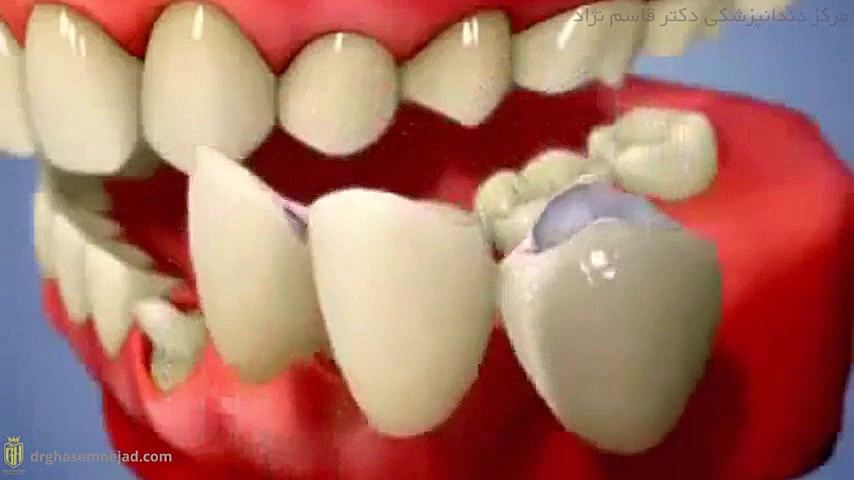 بریج دندان دندانپزشکی زیبایی دکتر قاسم نژاد