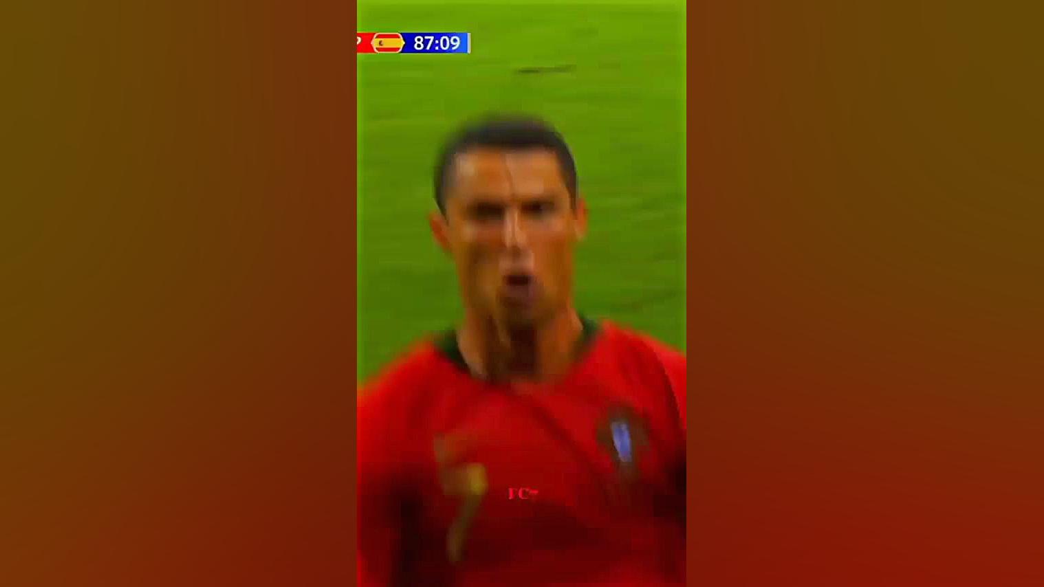 ronaldo جراحی پف زیر چشم