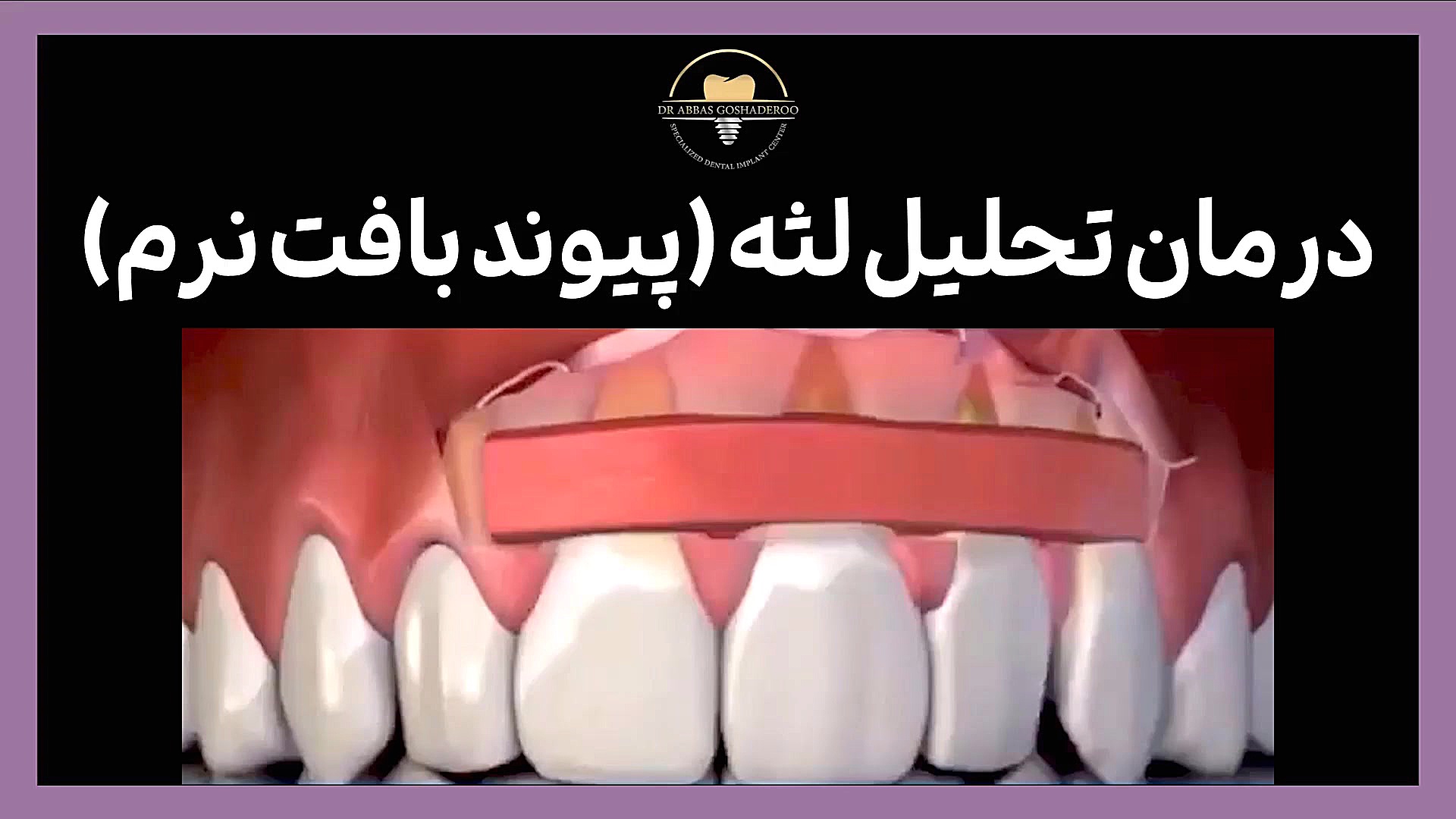 درمان تحلیل لثه با پیوند بافت نرم آزمون آنتی‌بادی خنثی‌کننده