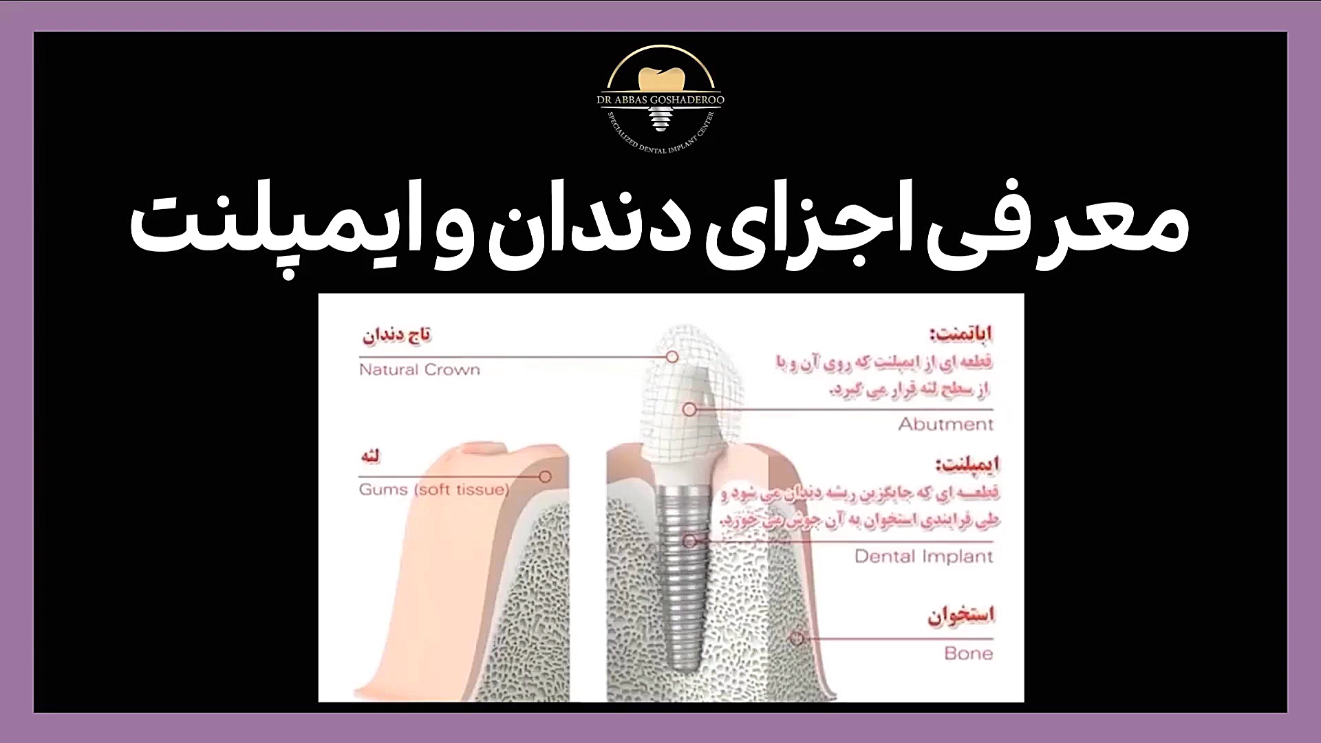 آشنایی با اجزای دندان و ایمپلنت دکتر عباس گشاده رو، متخصص جراحی لثه و ایمپلنت