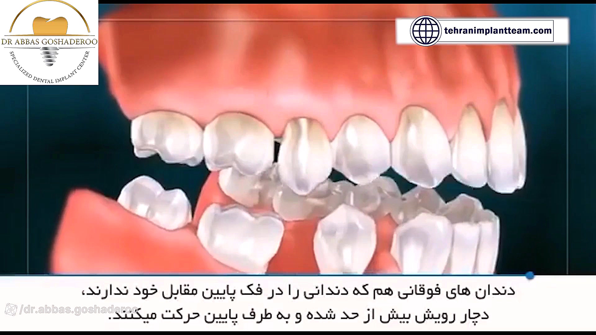 عوارض از دست رفتن دندان و اهمیت جایگزینی دندان از دست رفته دکتر عباس گشاده رو، متخصص جراحی لثه و ایمپلنت