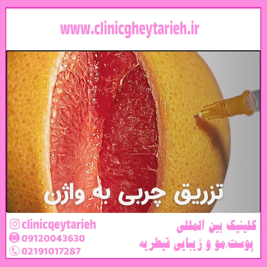 تزریق چربی به واژن 