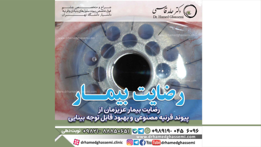 رضایت بیمار عزیزمان از پیوند قرنیه مصنوعی و بهبود قابل توجه بینایی کلینیک پوست