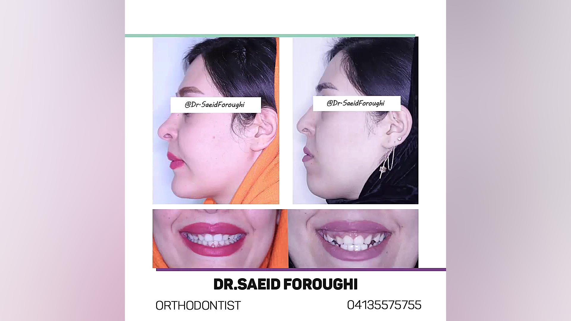 درمان ترکیبی ارتودنسی و جراحی فک در مراجعی با مشکل جلوبودن فک پایین نسبت به بالا تست آنتی‌بادی مونوکلونال