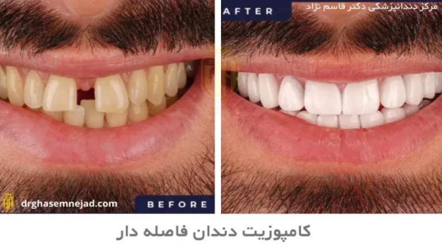 بستن فواصل دندان دندانپزشکی زیبایی دکتر قاسم نژاد