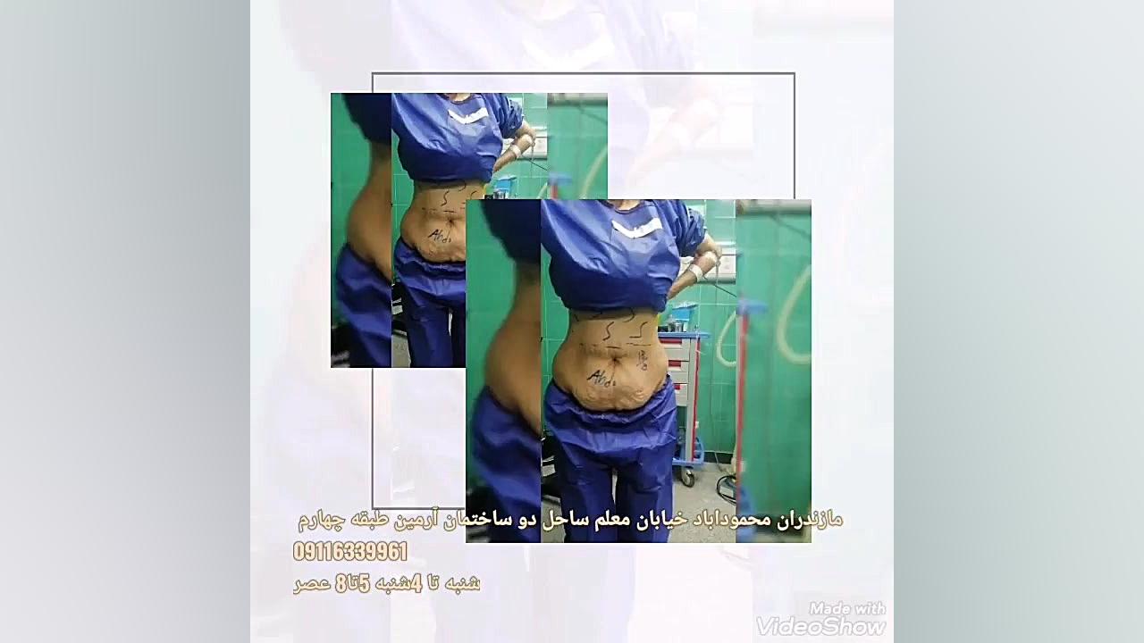 لیپوساکشن ابدومینوپلاستی دکتر ارسلان شیرویه جرمگیری