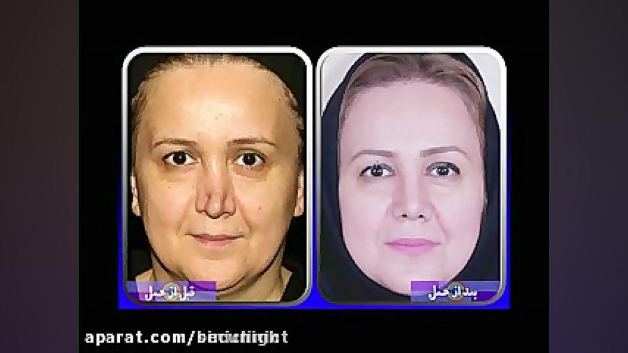 بیماری که سال ها بدنبال جراح ، برای عمل ثانویه بوده است دکتر حامد عباسی