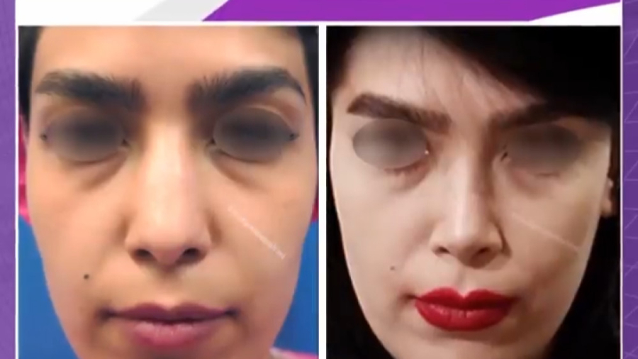 جراحی بینی استخوانی با پوست مناسب بیماری کیانسروماتوز صفاقی