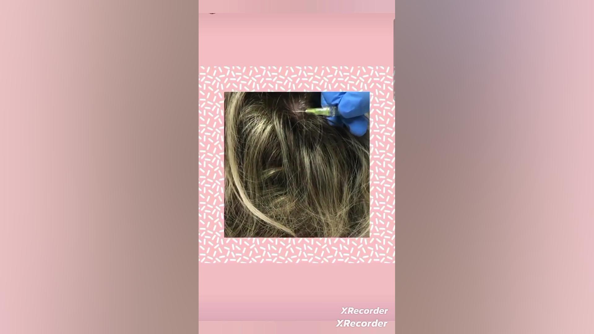 کربوکسی تراپی جهت کمک به تقویت ریشه مو و رفع ریزش مو نپتوکلیب