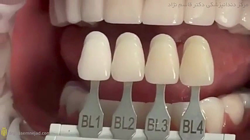 بهترین رنگ لمینت دندان دندانپزشکی زیبایی دکتر قاسم نژاد