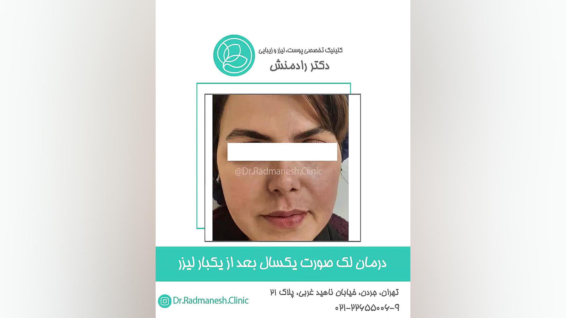 درمان لک صورت یکسال بعد از یک بار لیزر . پاکسازی پوست