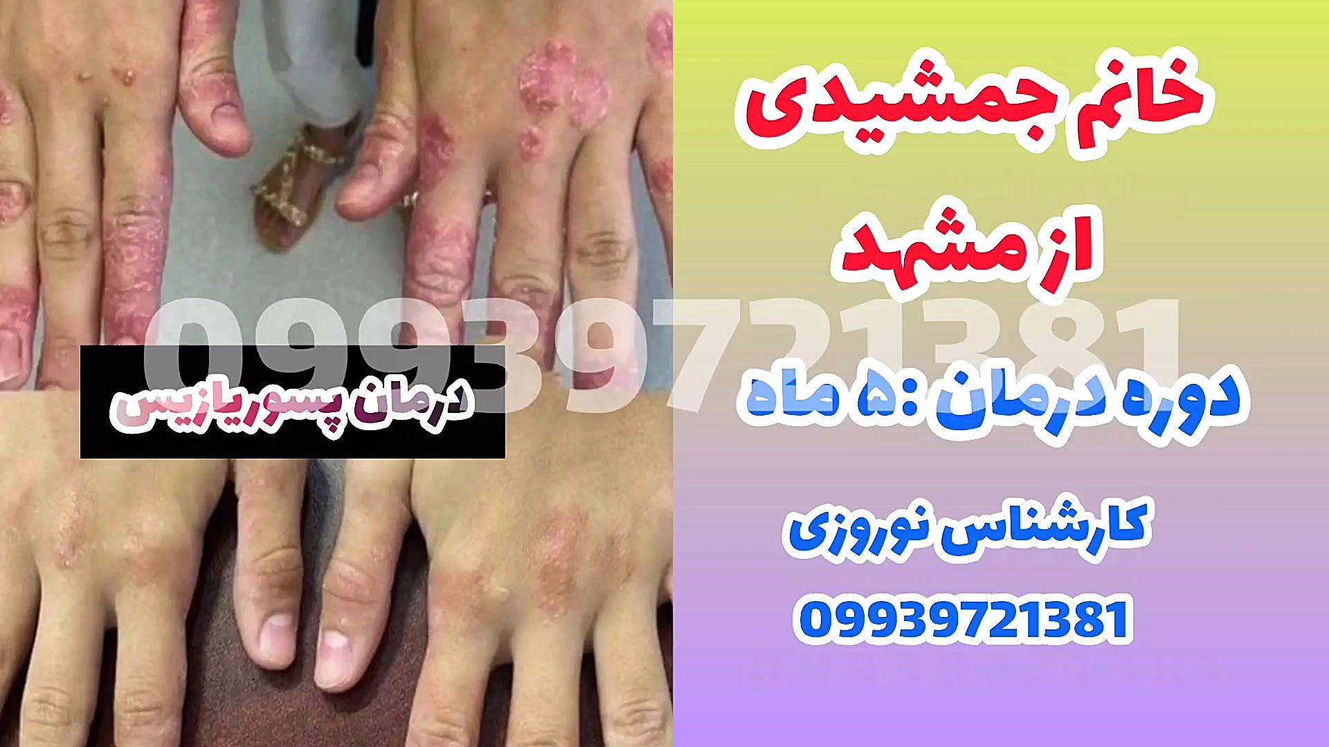 درمان ریشه ای پسوریازیس پروتز سینه