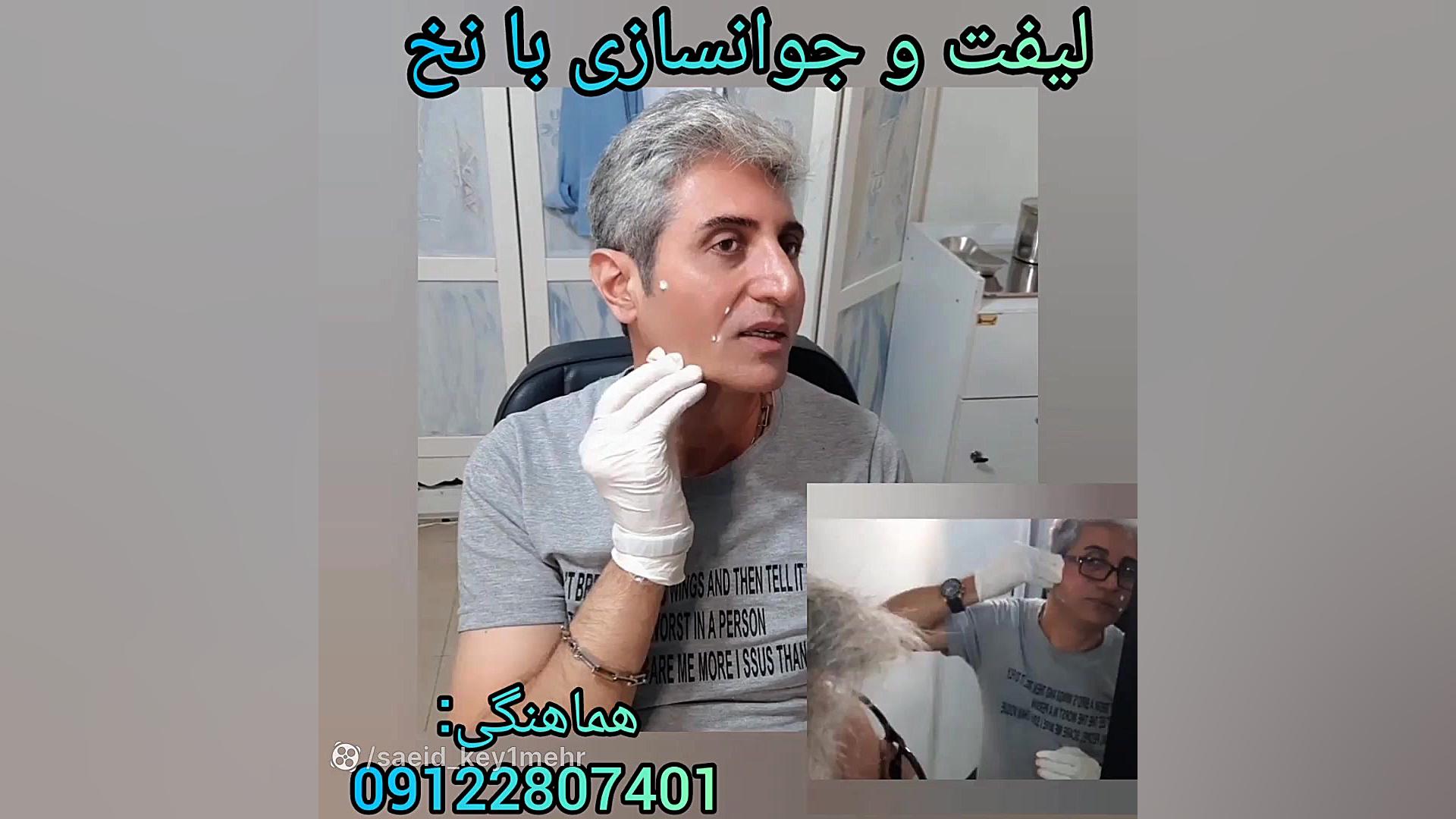 معجزه لیفت با نخ اندودنتیکس