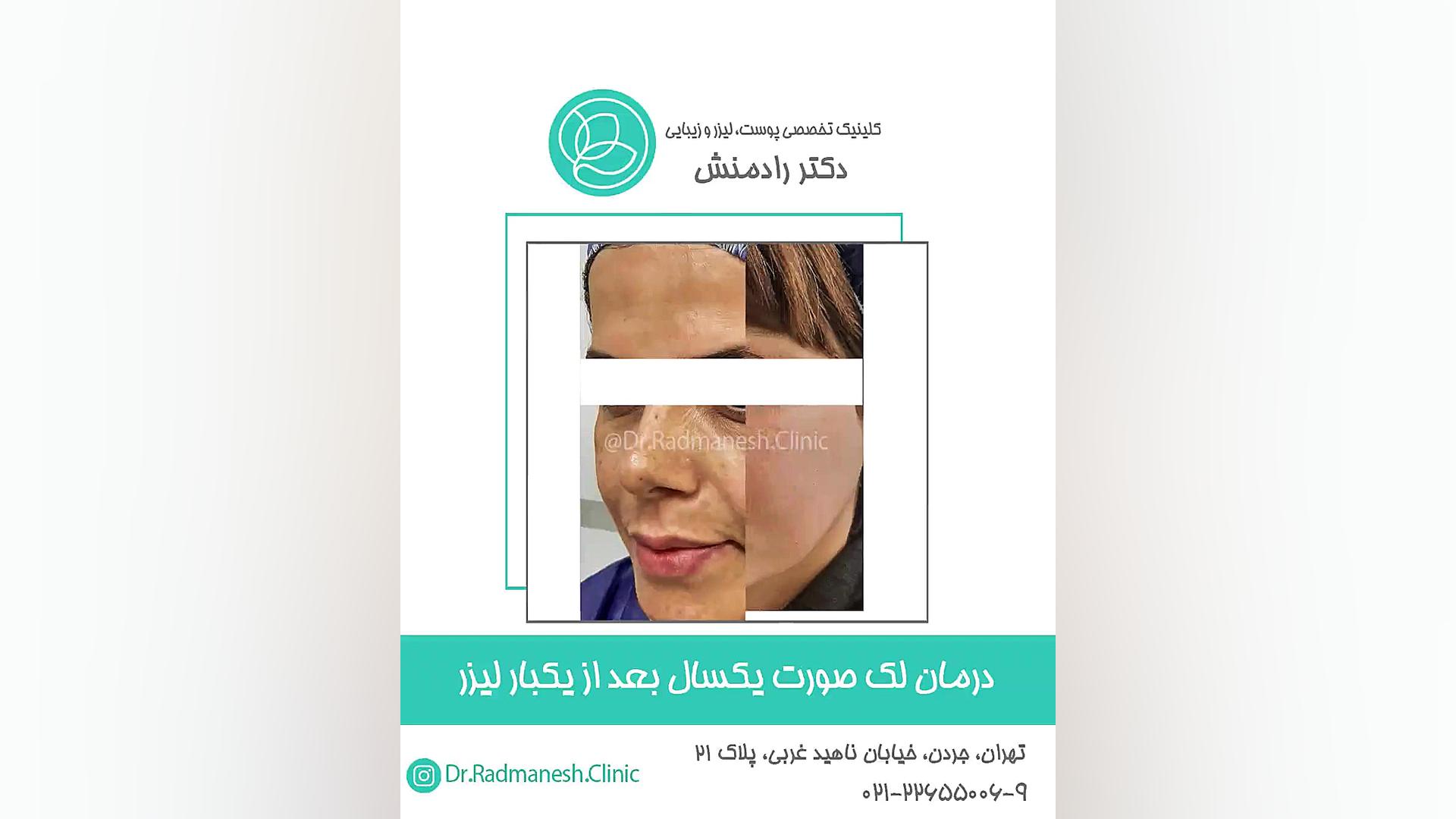 درمان لک صورت یکسال بعد از یک بار لیزر . دکتر پوست